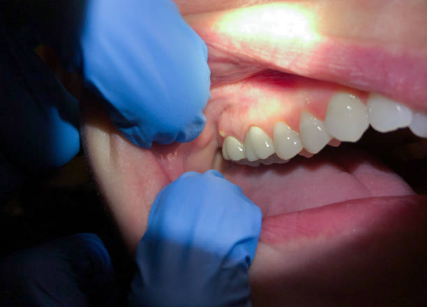 Best Urgent Care for Lost Fillings or Crowns in Country Club Estates, GA